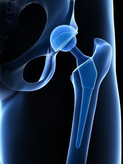 Anterior Approach Total Hip Replacement Surgery | Hip Joint Pain