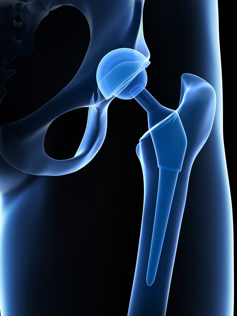 hip replacement metallosis