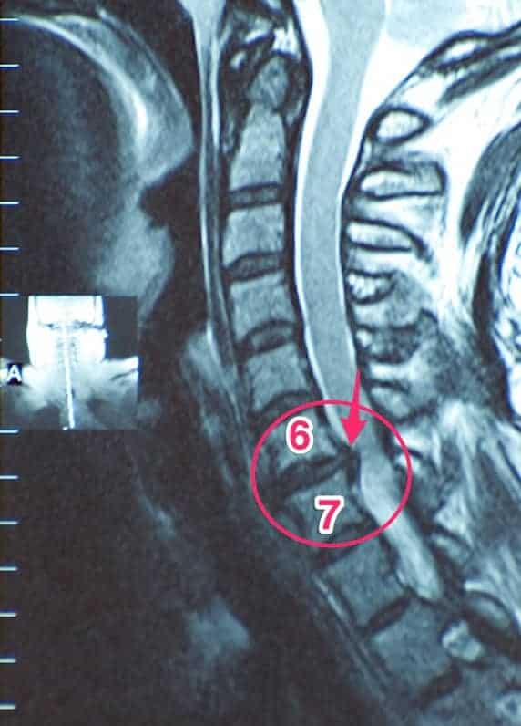 MRI Herniated Disc In Neck