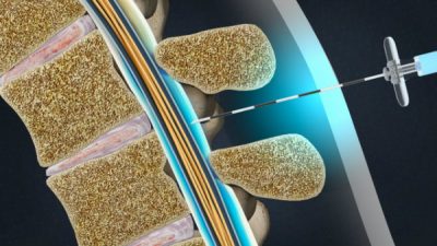 How Is the iFuse Implant System Revolutionizing Sacroiliac Joint Fusion ...