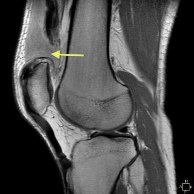 Bilateral Quadriceps Tendon Repair Gets Patient Back on the Job