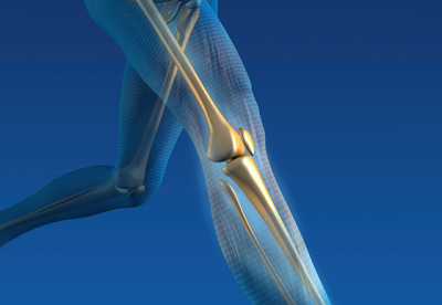 Innovative Nerve Blocks Ease Pain & Impact From Knee Replacements