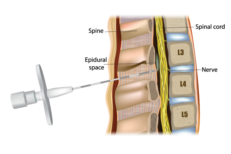 What Are Lumbar Injections for Back Pain? | Orlando Orthopaedic Center