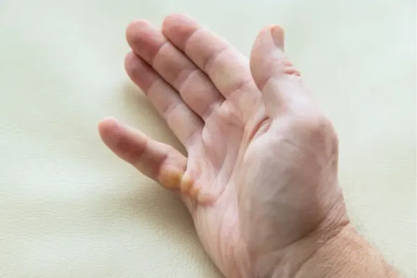 Minimally Invasive Dupuytren’s Contracture Treatment